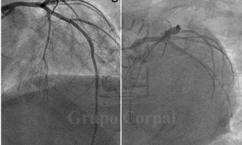 Insuficiencia cardíaca congestiva