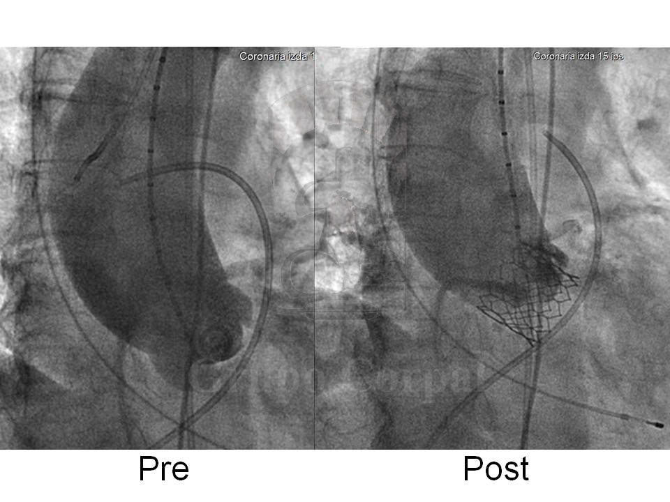 Imagen angiografica pre y post implante de válvula