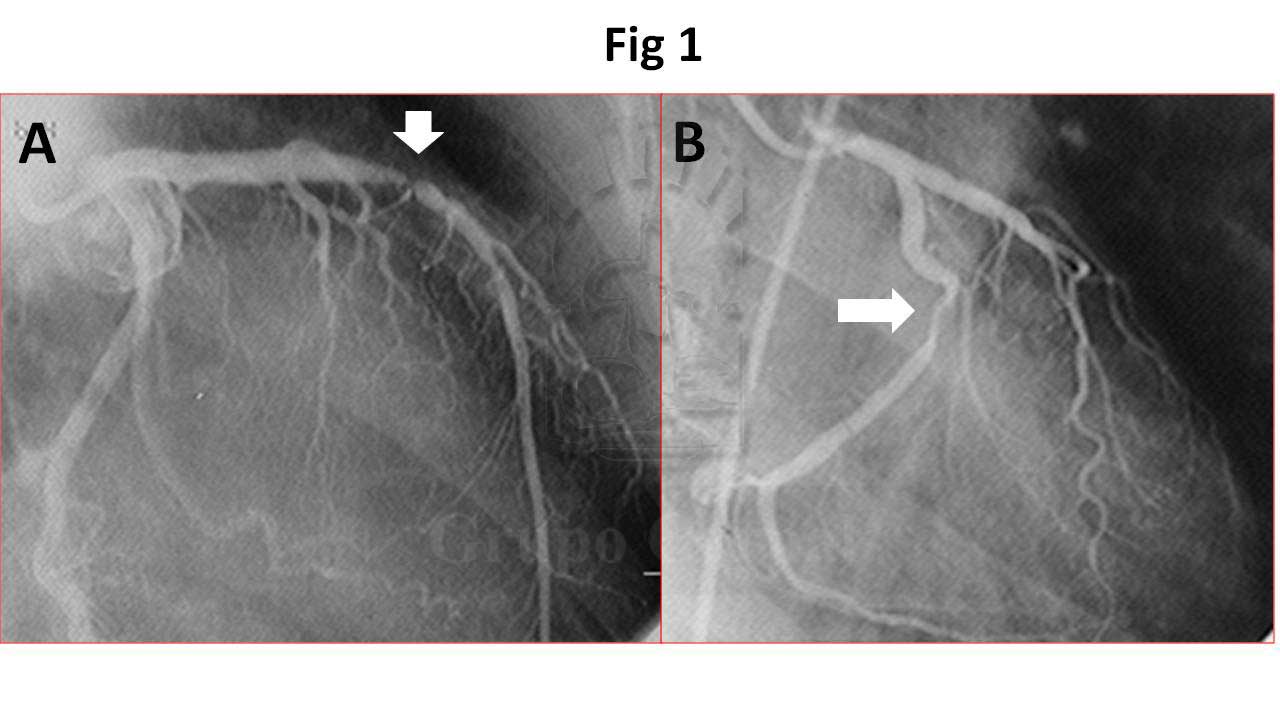 Luminografias de coronaria izquierda de dos pancientes con angina de pecho