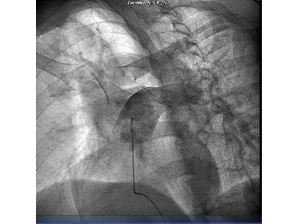 Inyección de contraste en proyección 4-cámaras en la que se observa una contrastación del árbol arterial izquierdo y ausencia de contrastación del de pulmón derecho.