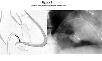 Ablación del Istmo Cavo tricuspídeo paciente con Flutter Auricular